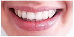 Fast unsichtbare Zahnschiene (Aligner) für eine entspannte Zahnkorrektur